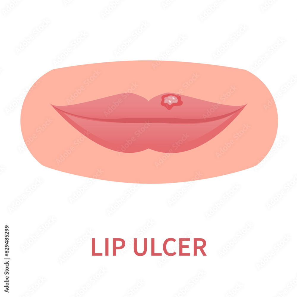 Lip ulcer oral disease icon. Lips inflammation, irritation, and ulceration with cracked and peeling skin. Painful sores, blisters, lesions. Dermatitis outbreak. Medical concept. Vector illustration.