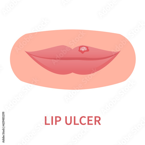 Lip ulcer oral disease icon. Lips inflammation, irritation, and ulceration with cracked and peeling skin. Painful sores, blisters, lesions. Dermatitis outbreak. Medical concept. Vector illustration.