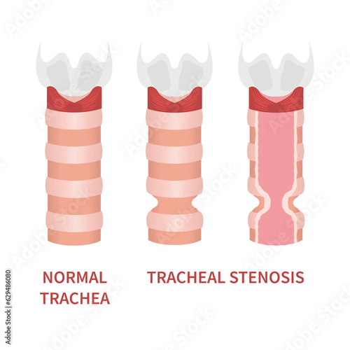 Tracheal stenosis awareness illustration. Trachea narrowing symbol. Difficulty breathing, hoarseness and voice change symptoms. Healthcare concept. Isolated flat vector illustration.