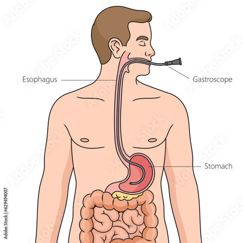 Nasogastric intubation diagram schematic vector illustration. Medical science educational illustration