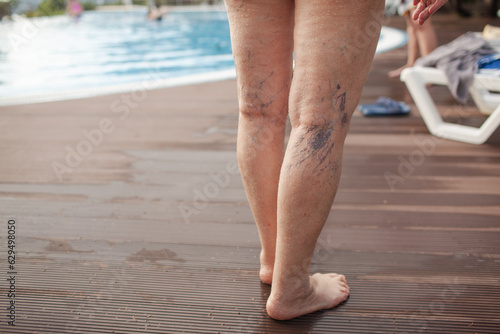 close-up of female old legs with varix