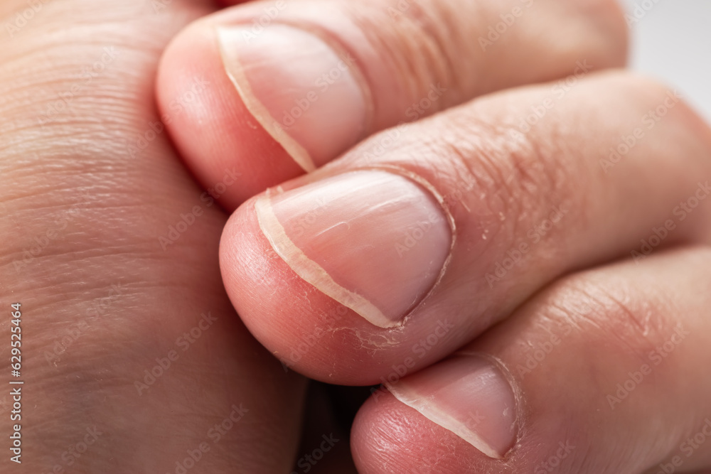 Ridged fingernails with vertical ridges.Nails problems Ridged fingernails with vertical ridges.Nails problems