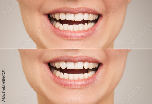 close-up photo of female teeth before and after the installation of the bracket system. The concept of comparison. Dentistry and orthodontics. The result of bite correction.