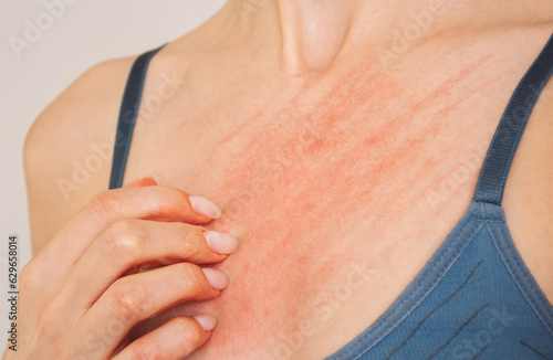 photo of a woman in blue underwear who scratches her breasts and suffers from allergies, itching, skin rash, dermatitis. Allergic reaction. Skin diseases. Healthcare concept photo