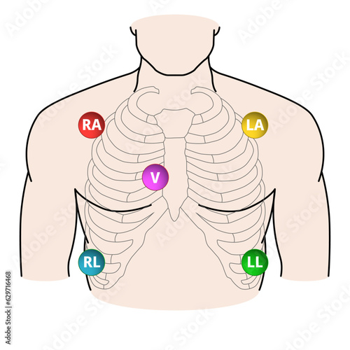 5 Lead Electrode Placement Electrocardiogram - RA, LA, RL, LL, V - Position of ECG 5 Leads - Vector Medical Illustration