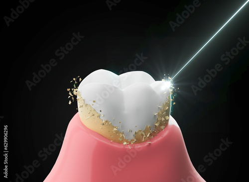 Φωτογραφία scaling teeth, Tartar removal, Oral hygiene and Dental concept, 3d rendering