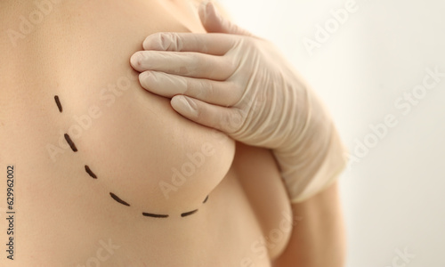 Photos Female breast marked for plastic surgery in clinic