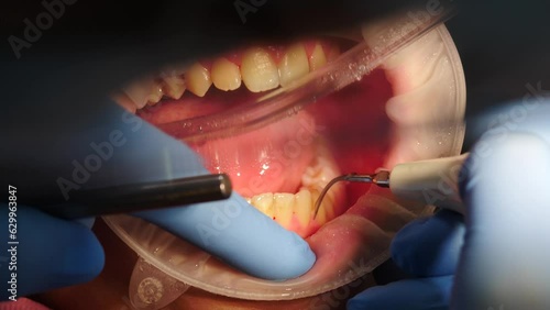 Dentistry and oral hygiene. Dental whitening work. dental care and stomatology. Teeth cleaning removing plaque stones. Professional cleaning dental plaque and polishing childs teeth, Pediatric