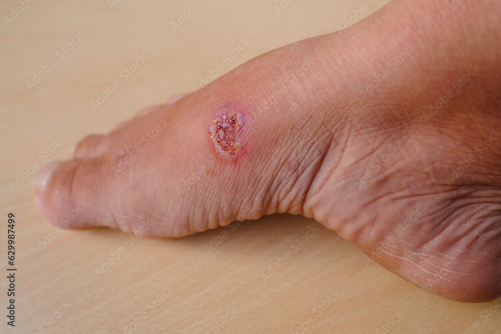 closeup of weeping wound, trophic ulcer on female leg, wound exudate closeup of weeping wound, trophic ulcer on female leg, wound exudate