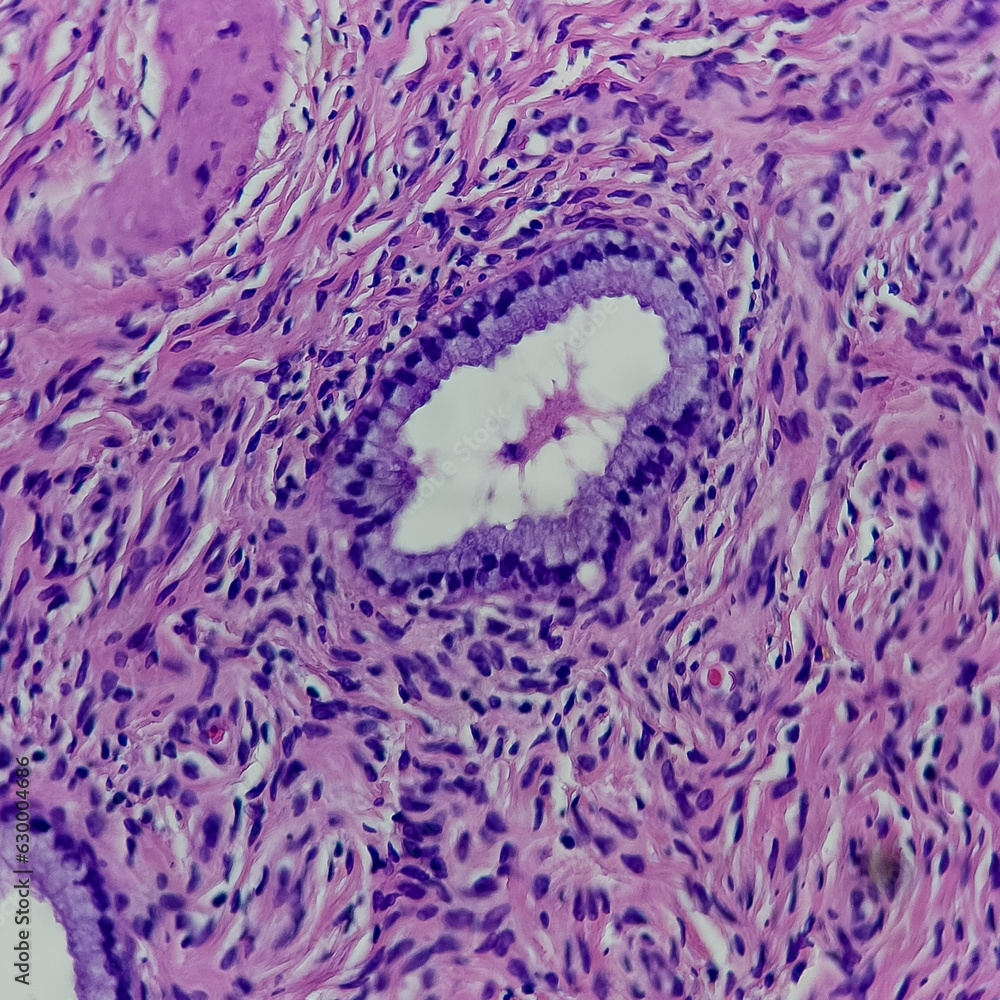 Camera photo of benign endocervical glands, showing columnar epithelial