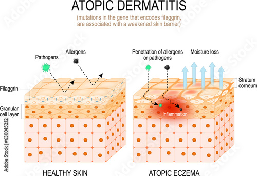 Filaggrin and Atopic dermatitis. eczema