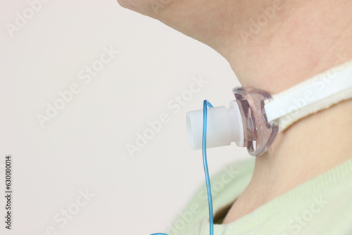 Close up view of a tracheostomy in a adult woman neck. Woman wearing casual clothes with a tracheostomy 