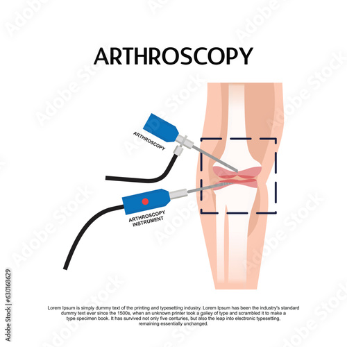 Arthroscopy medical treatment surgery keyhole surgical treat endoscope
