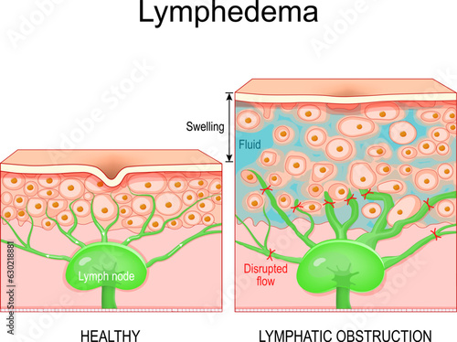Lymphedema. Cross section of a human skin
