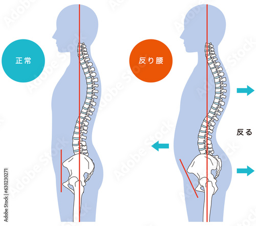 Cuadro en lienzo 反り腰の姿勢　比較