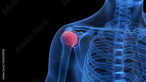 Animation of an inflamed shoulder photo