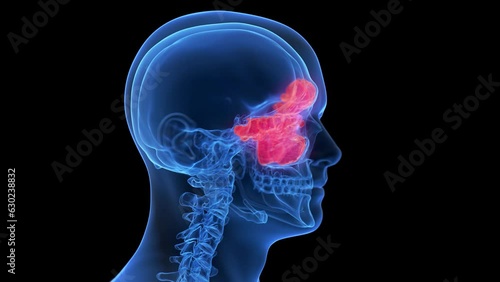 Animation of inflammation of Animation of sinuses