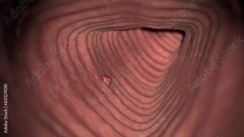 Animation of cancerous tumour growing in large intestine