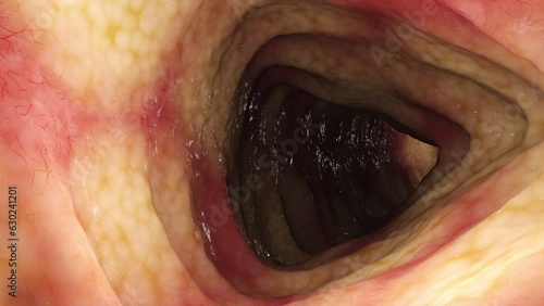 Animation of Crohn's Disease affecting colon