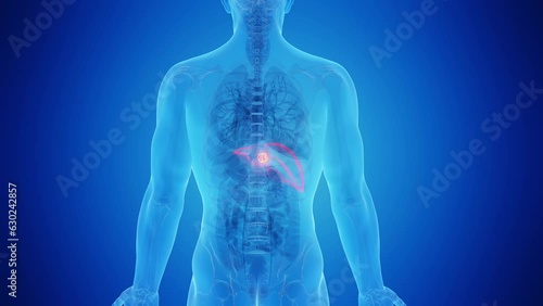 Wallpaper Mural Animation of a malignant mass in a man's liver Torontodigital.ca