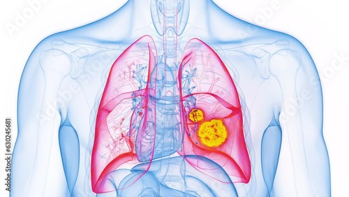 Animation of malignant masses in a man's lung photo