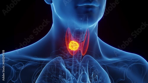 Animation of a thyroid carcinoma in an adult male