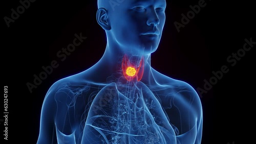 Animation of thyroid cancer in a man