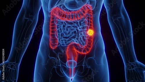 Animation of colon cancer in a man photo