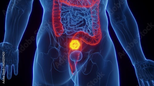 Animation of a cancerous tumor in a man's rectum