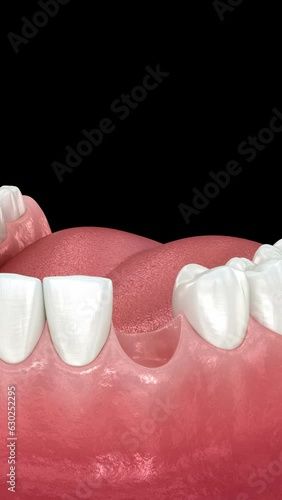 Dental implant installation and crown placement. 3d animation photo