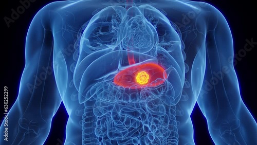 Animation of stomach cancer in an adult male photo