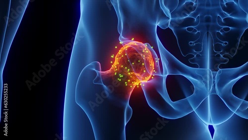 Animation of a man's inflamed hip joint undergoing repair, photo