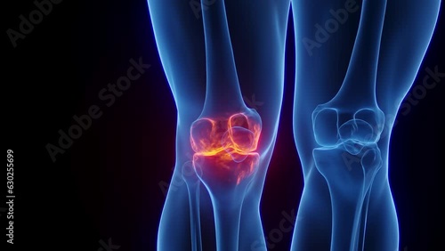 Animation of arthritis at a man's right knee joint
