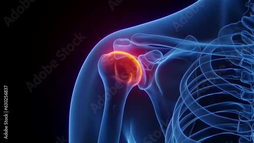Animation of a man's inflamed right shoulder photo