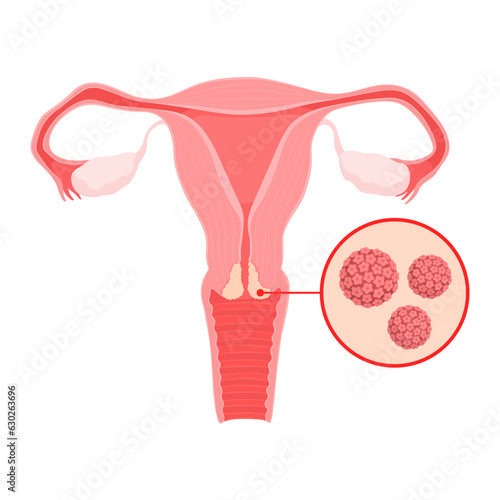 HPV infection of uterine cervix