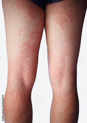 Dermatitis, Asian man, man pinches leg allergy, allergic reaction, insect bites, hand scratching, itchy red spots or skin rash. beauty problems from medical treatment