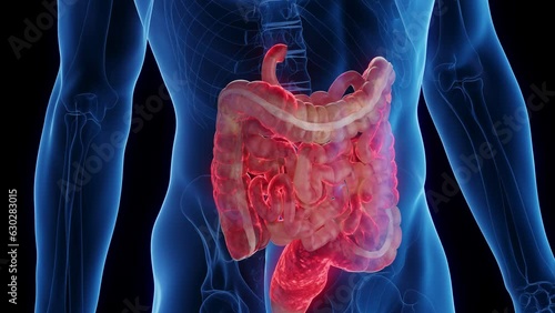 Animation of a man's intestines affected by Crohn's disease photo