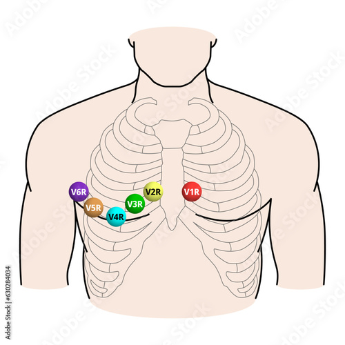 Right Sided ECG Electrode Placement - Electrocardiogram Lead V1R, V2R, V3R, V4R, V5R, V6R Positions - Medical Vector Illustration