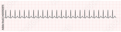 EKG Monitor Showing  Supraventricular Tachycardia