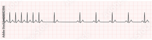 EKG Monitor Showing  Supraventricular Tachycardia Change to Sinus Rhythm After Adenosine Injection photo