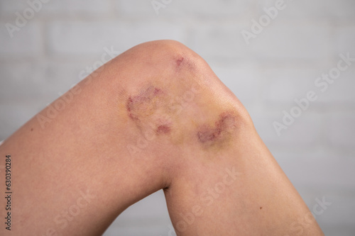 Close-up of bruises on the skin of an injured woman s legs