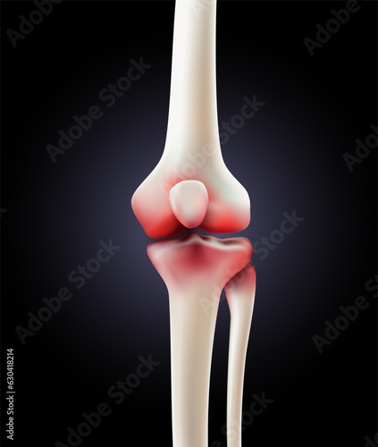 Skeleton showing the cause of painful knee arthritis. vector illustration file.