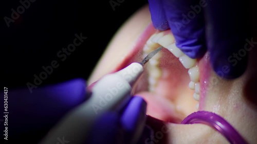 Real footage of a professional dentist cleaning the upper teeth of a woman patient from plaque and calculus with an electric tool using a strong jet of water close-up. Dental care