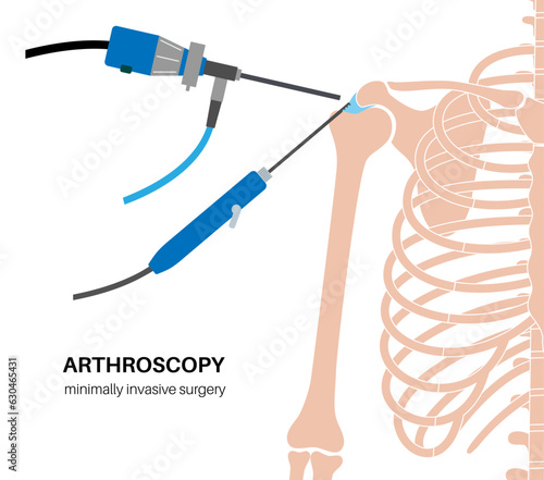 Shoulder arthroscopy poster