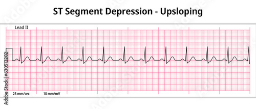 ECG ST Segment Depression - 8 Second ECG Paper - Electrocardiogram Vector Medical Illustration