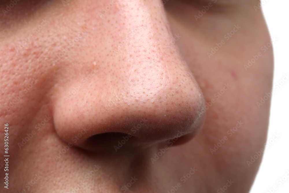 Young woman with acne problem on white background, closeup view of nose Young woman with acne problem on white background, closeup view of nose
