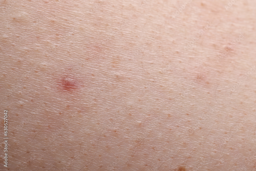 Young person with acne problem, closeup view of skin Young person with acne problem, closeup view of skin