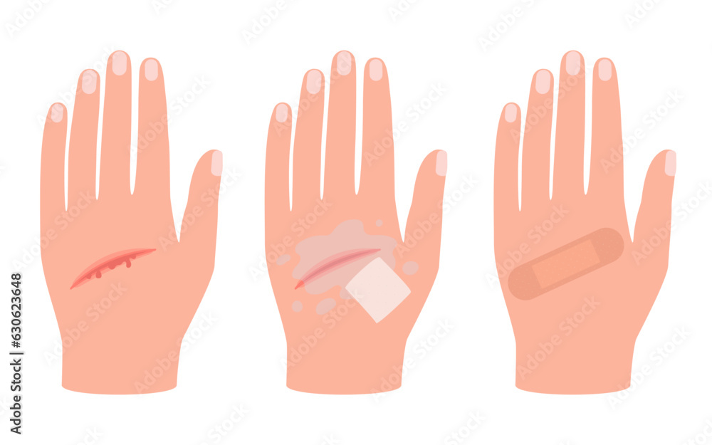 Wound of hand human skin, scratch. First aid for cut injury skin, bleeding cut. Clean and disinfection wound, patch for safe health. Vector Wound of hand human skin, scratch. First aid for cut injury skin, bleeding cut. Clean and disinfection wound, patch for safe health. Vector