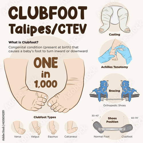 Line art vector of the process of clubfoot treatment. Ponseti Method. Clubfoot infographic. photo