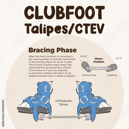 Line art vector of clubfoot. Ponseti Method. Foot turn inward or upward. Clubfoot bracing phase infographic